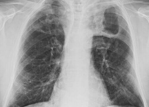 An x-ray confirming tuberculosis (the white in the x-ray shows the infection).